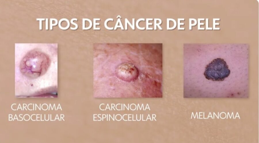 64bd41c3c01e5 nandinho cancer pele 3