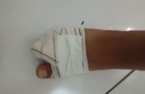 Homem perde parte do dedo após ser atacado por cachorro de rua e culpa protetor de animal em Patos