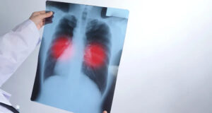 Paraíba registra mais de 1.580 casos de tuberculose em 2025